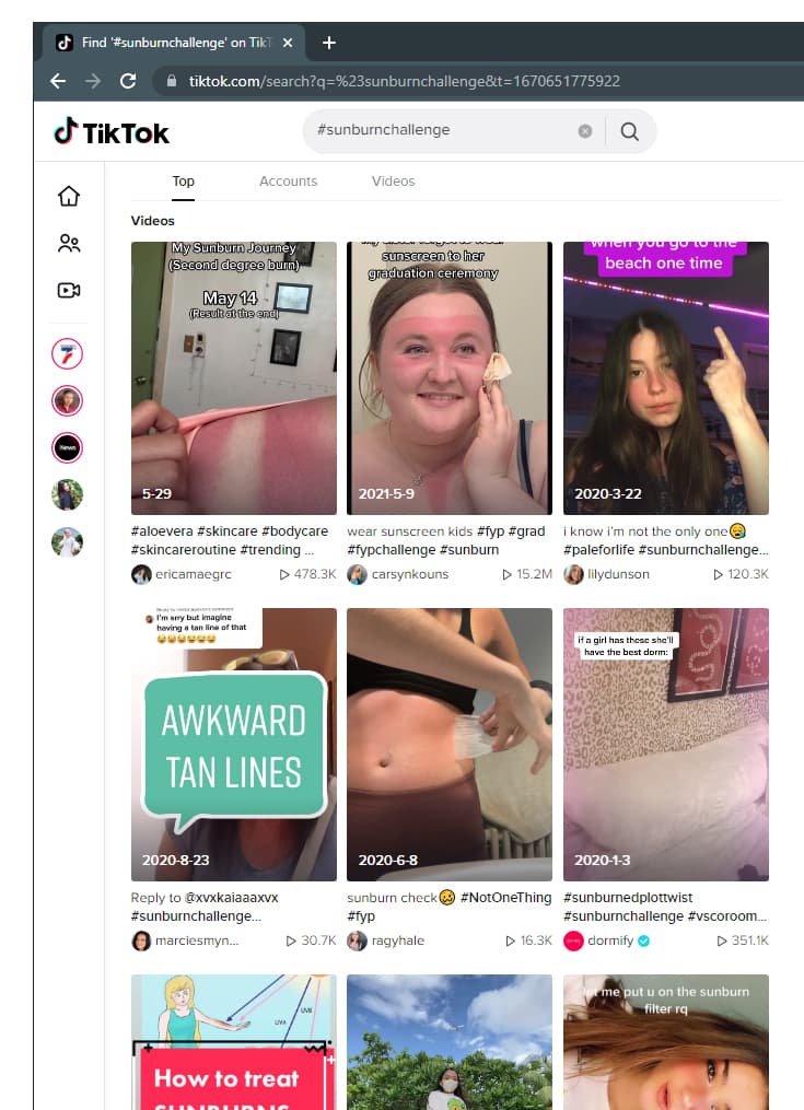 TikTok, sunburn challenge